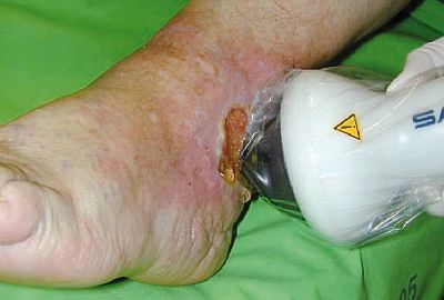 Sebkezelés DermaPACE készülékkel 
