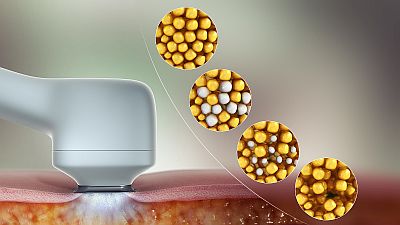 Zsírfagyasztás, cryolipolysis, kriolípolízis